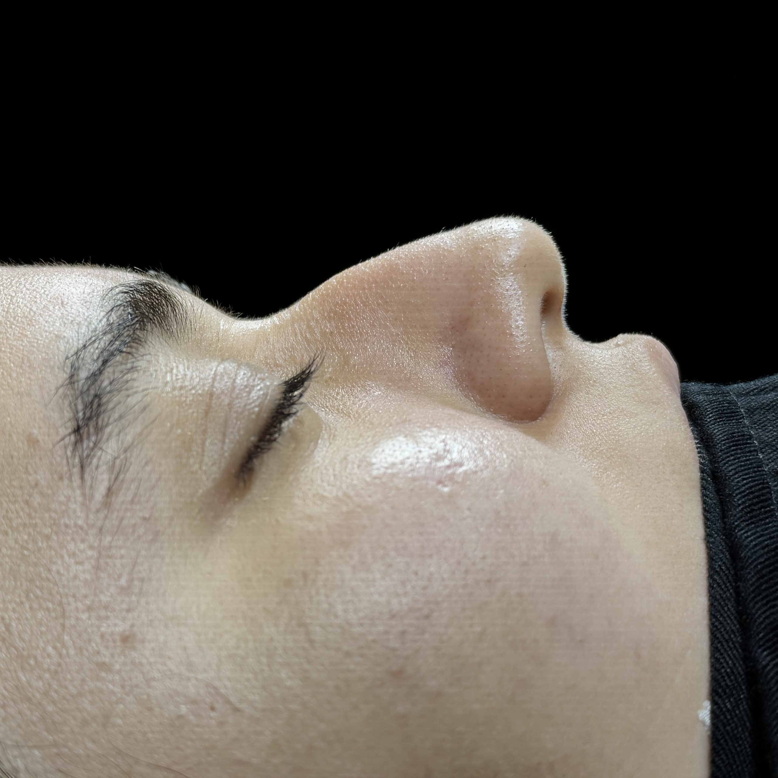 Casos de Rinoplastia