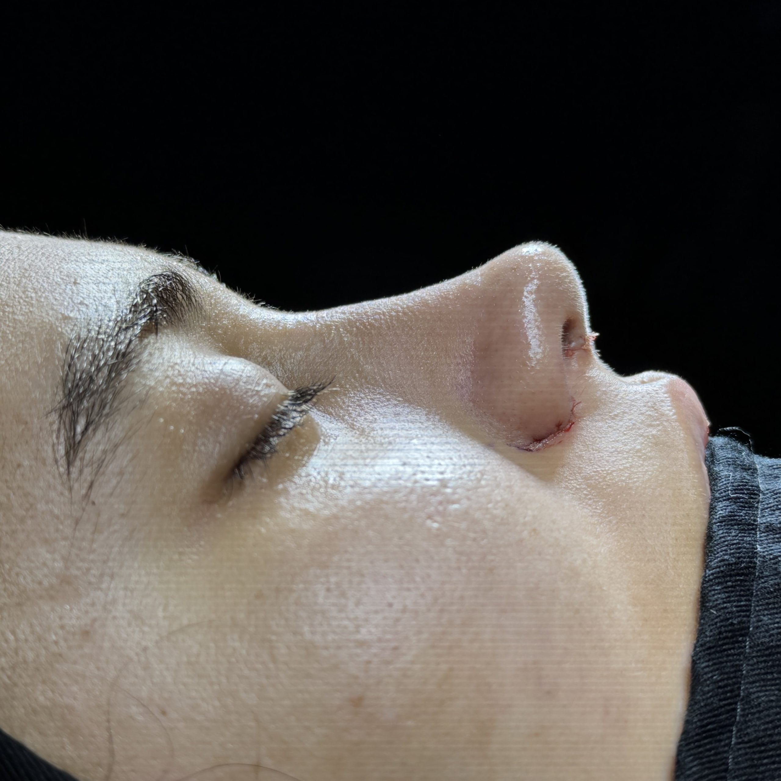 Casos de Rinoplastia