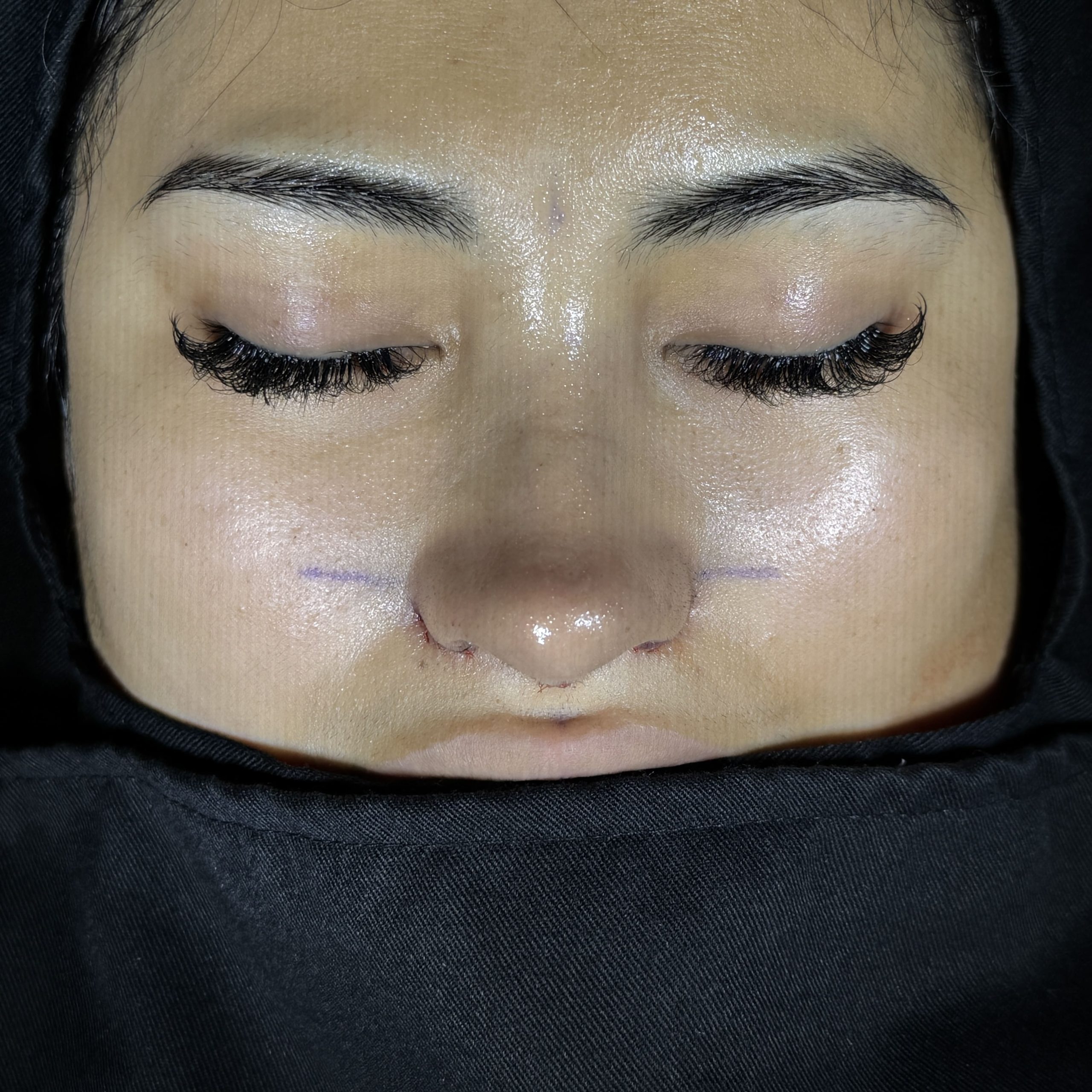 Casos de Rinoplastia