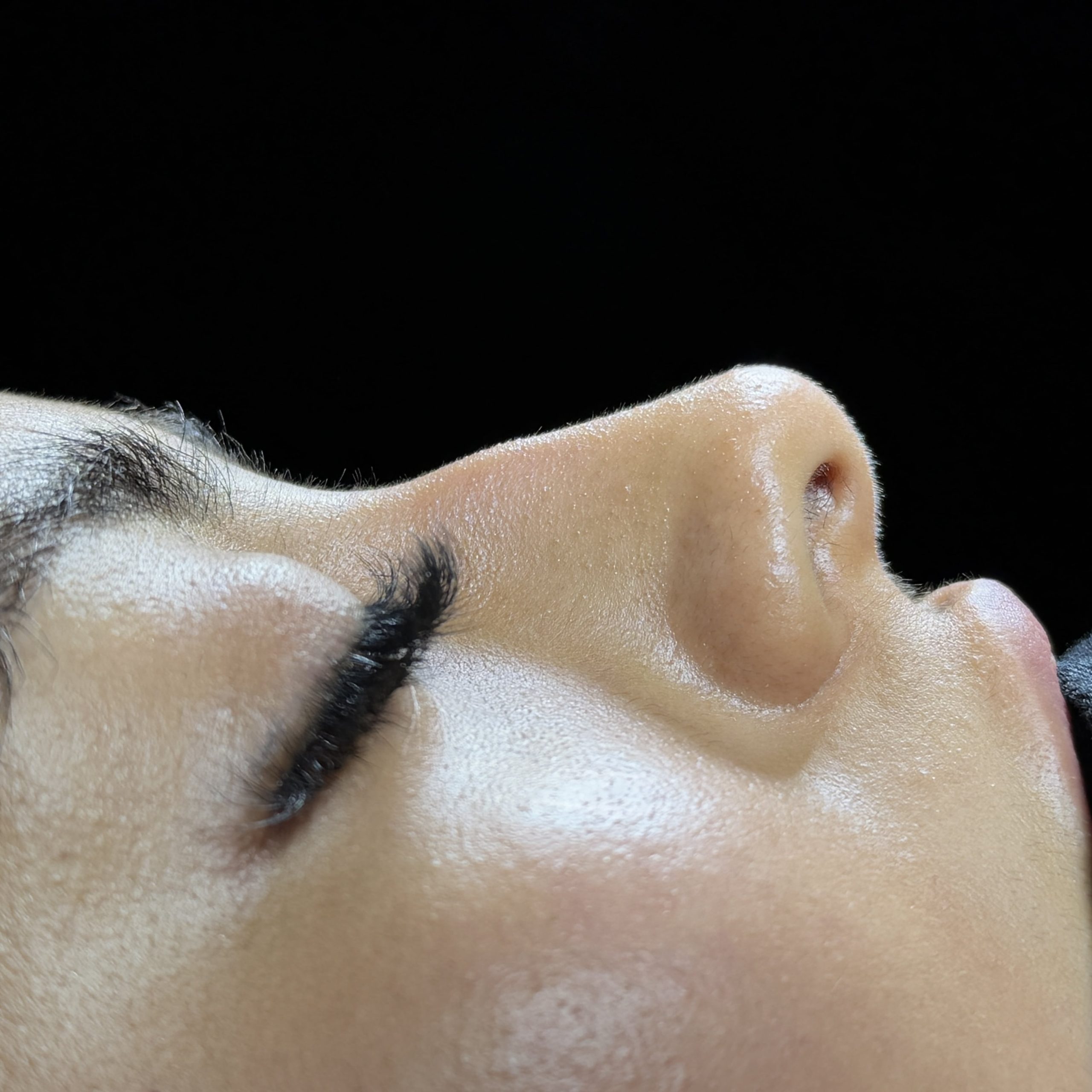 Casos de Rinoplastia