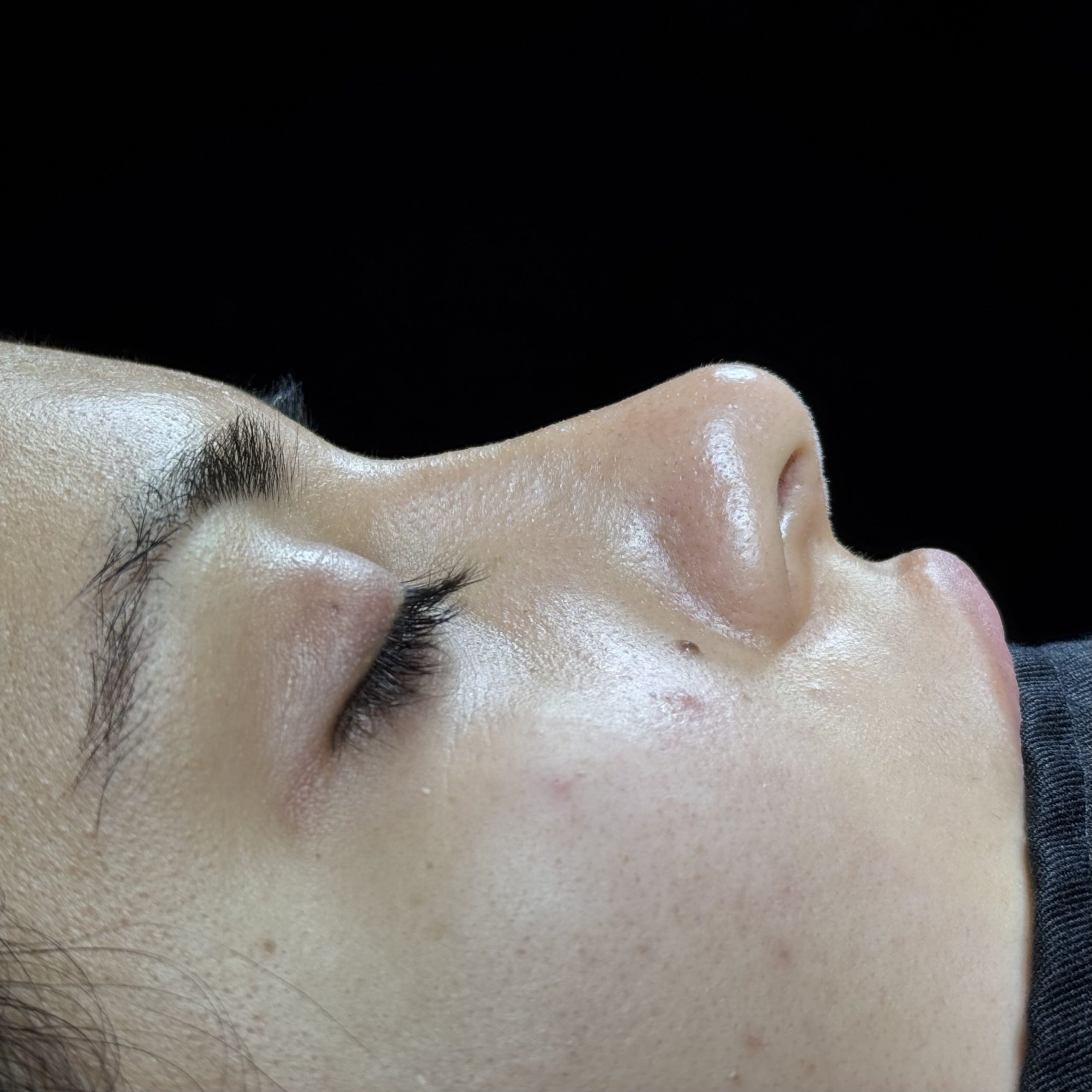 Casos de Rinoplastia