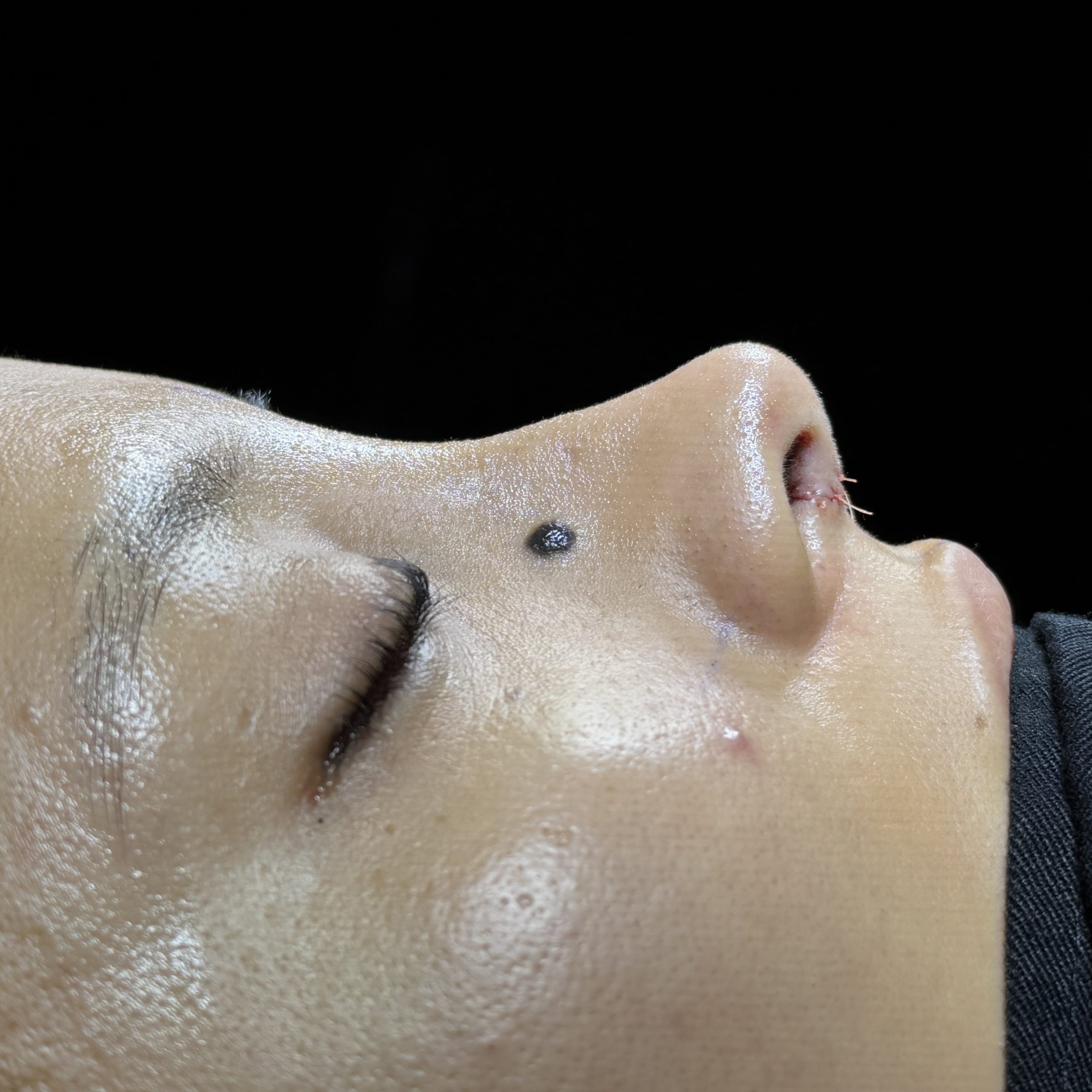 Casos de Rinoplastia