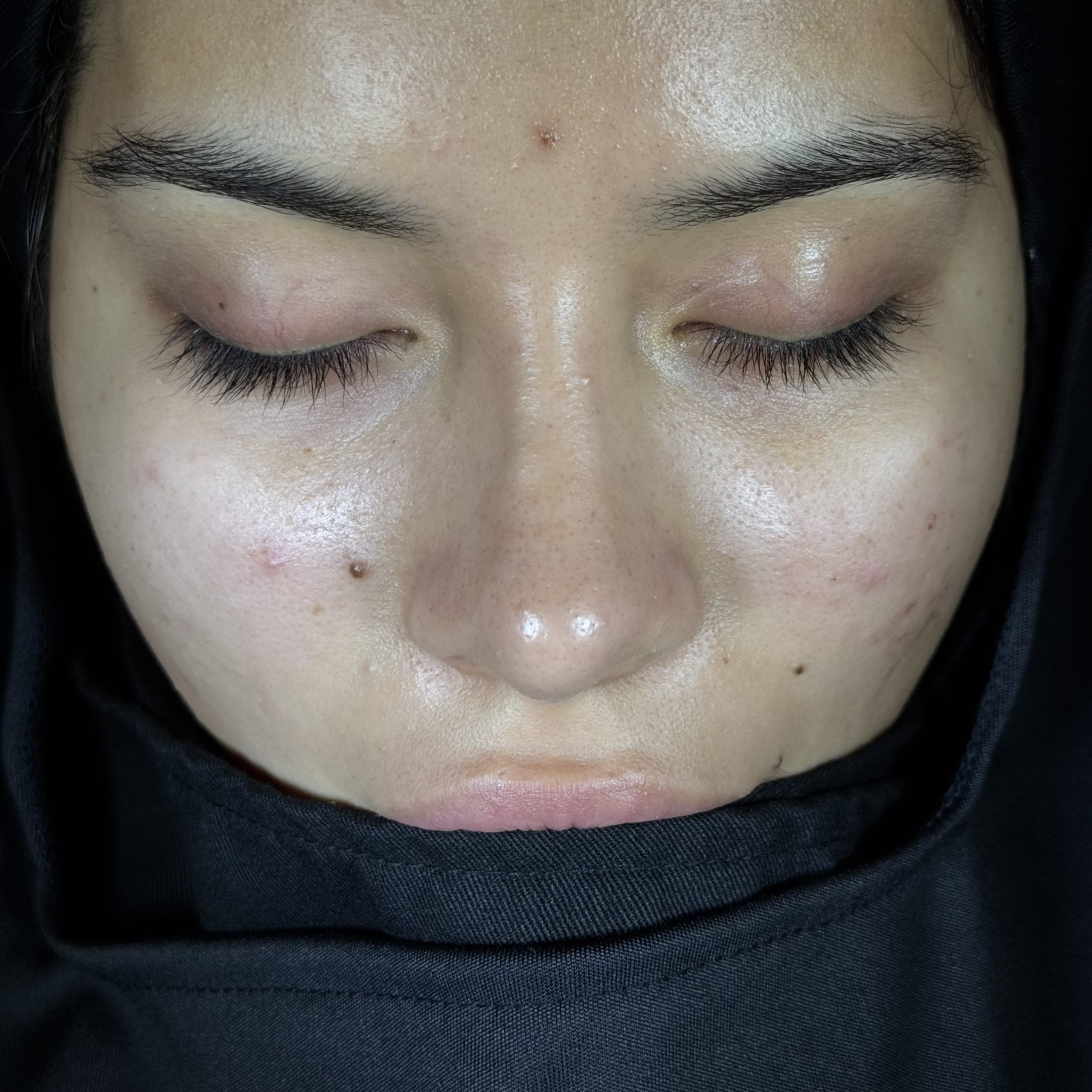 Casos de Rinoplastia