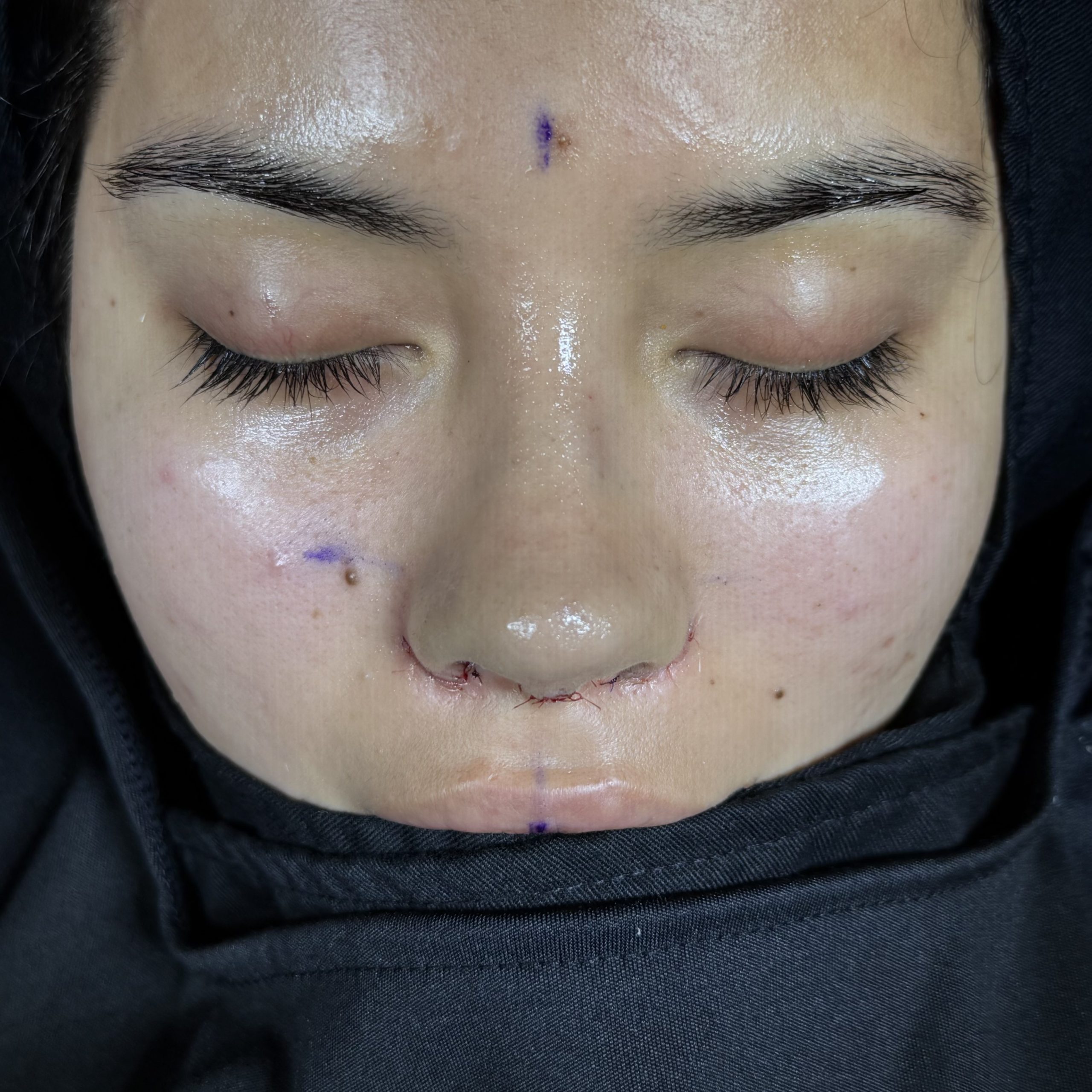 Casos de Rinoplastia