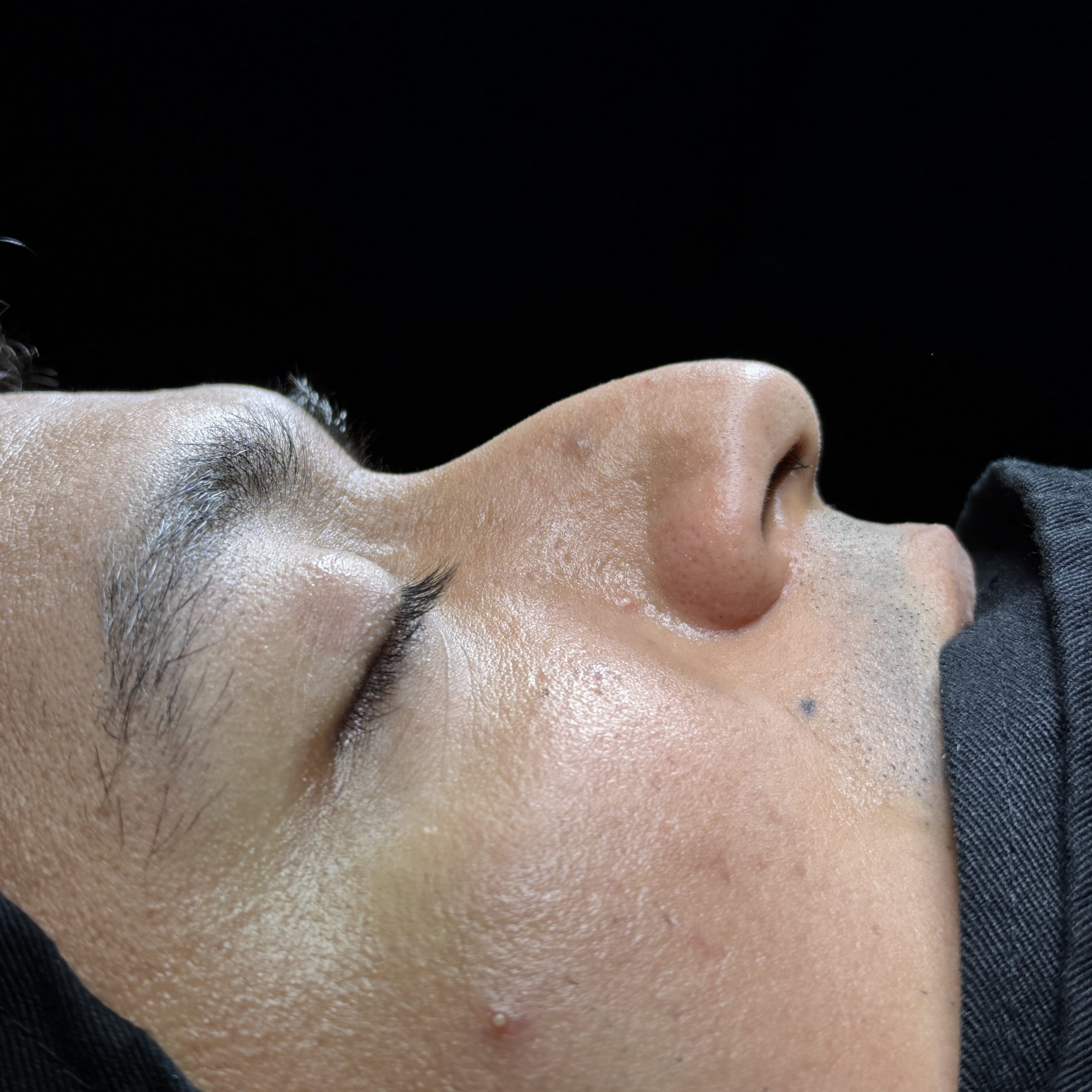 Casos de Rinoplastia