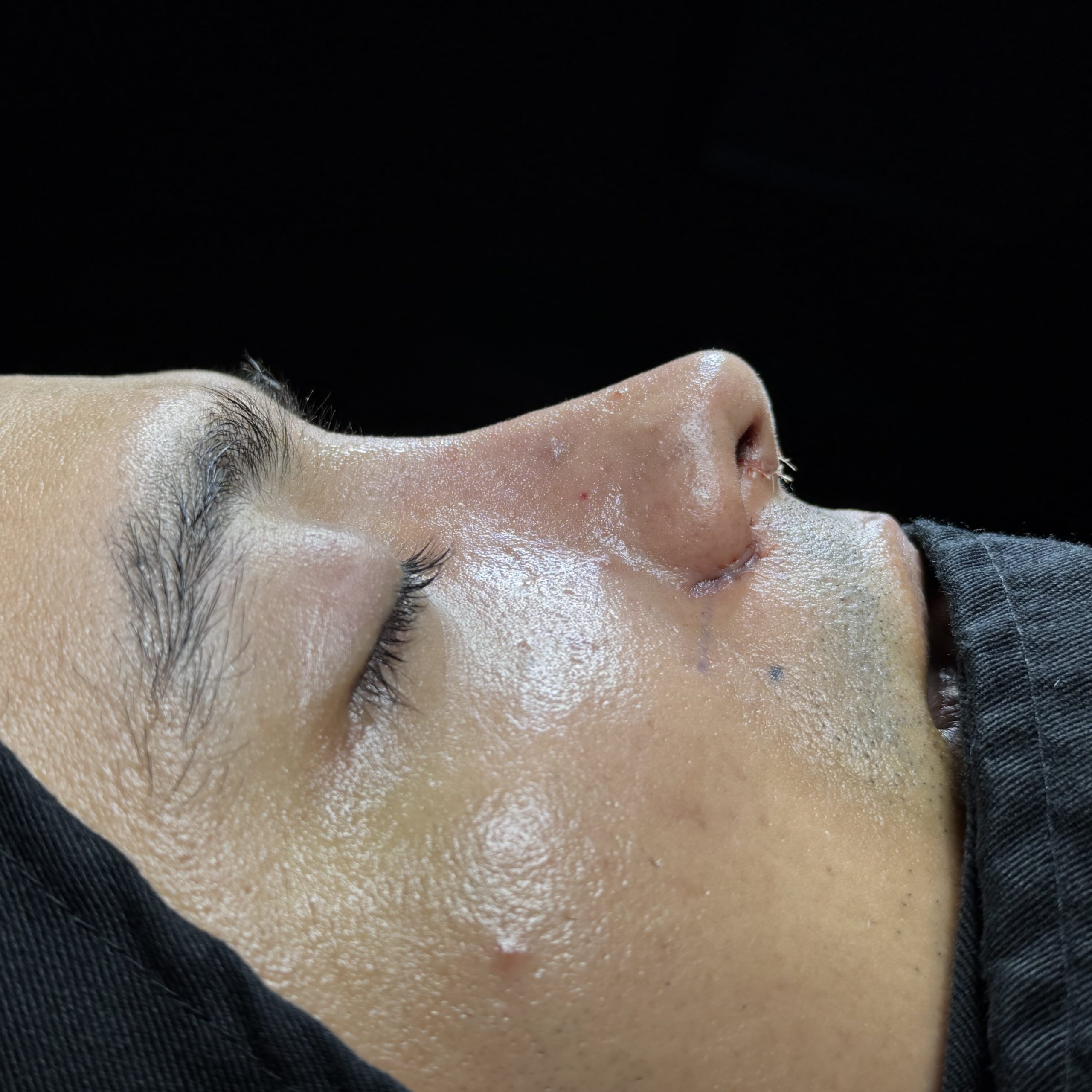 Casos de Rinoplastia