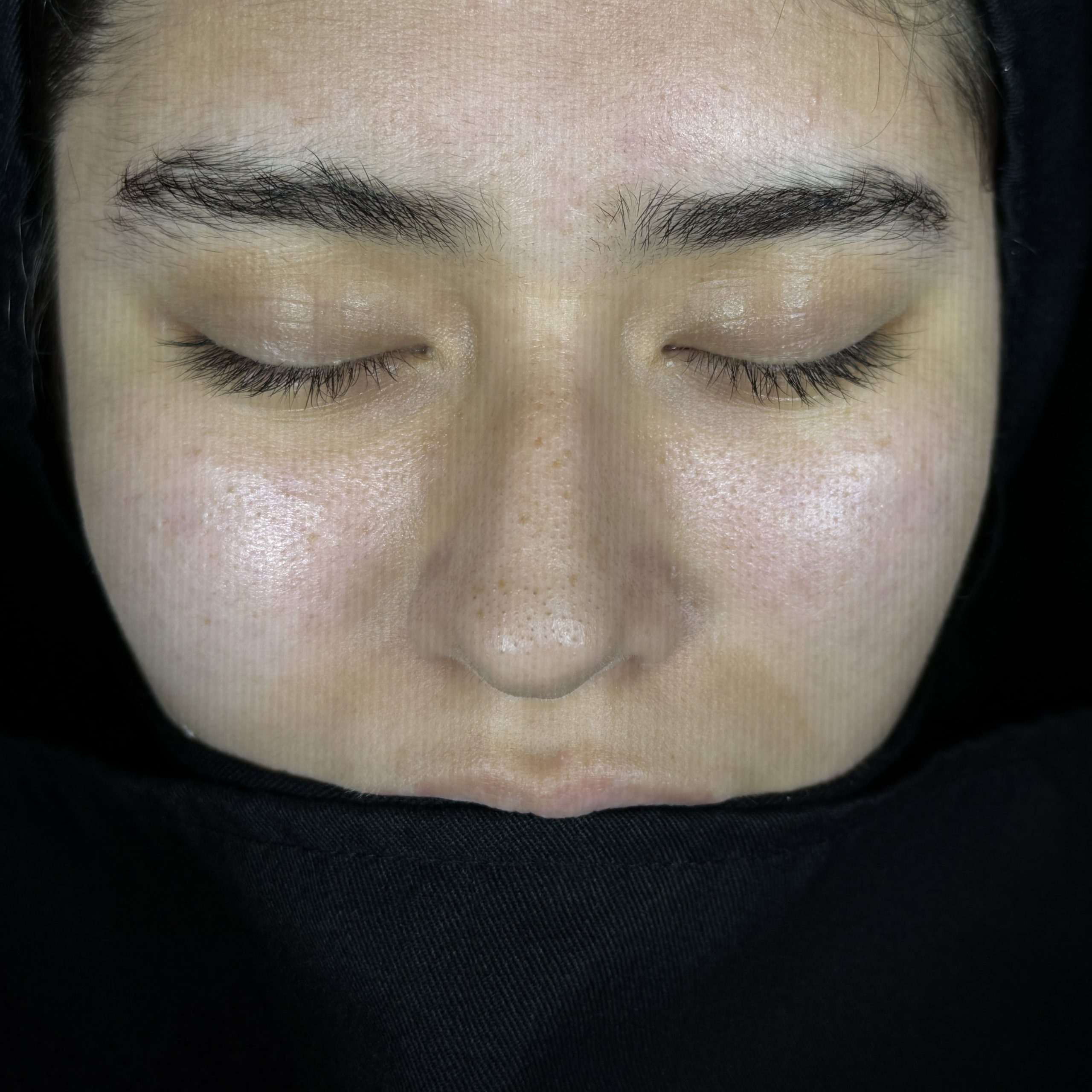 Casos de Rinoplastia