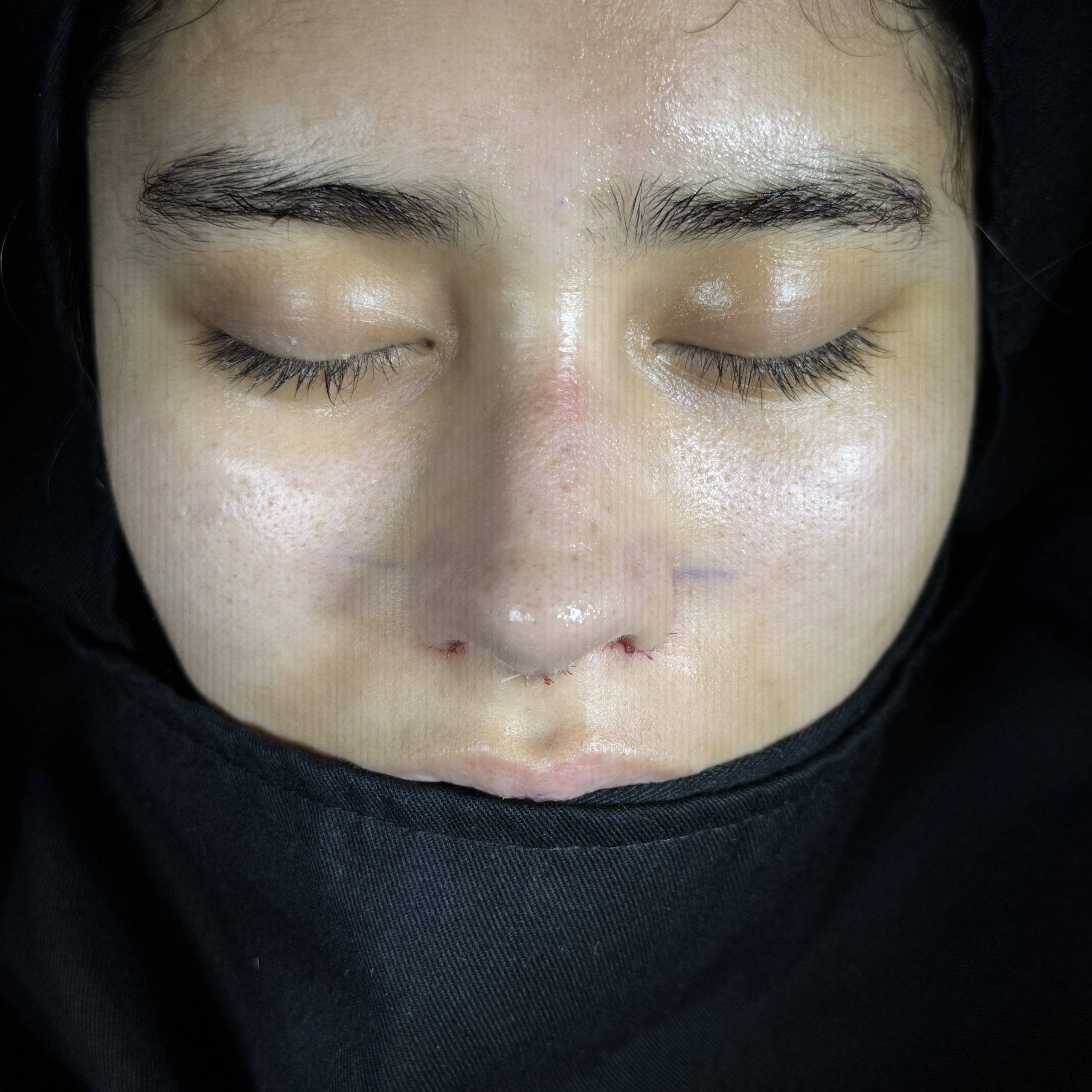 Casos de Rinoplastia