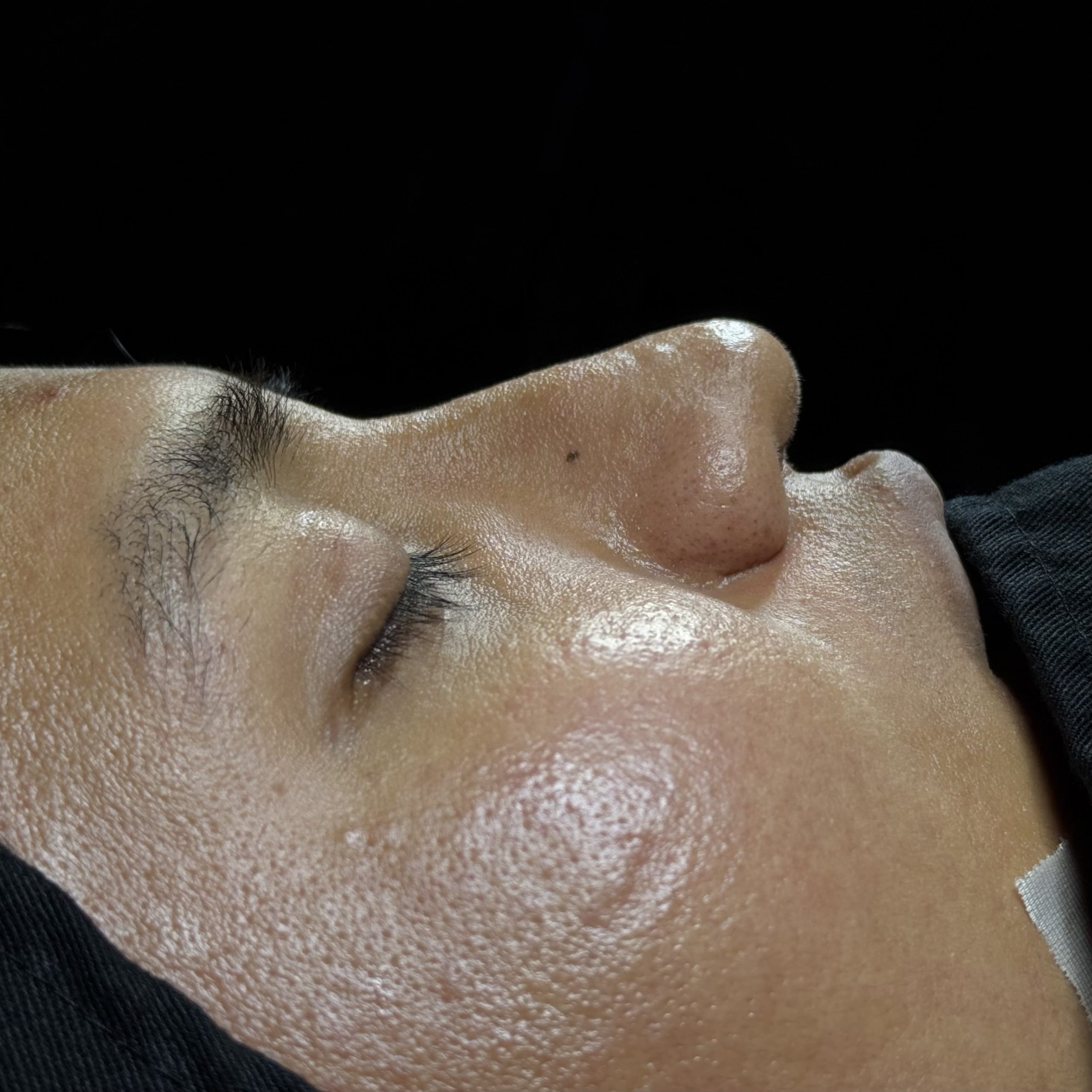 Casos de Rinoplastia