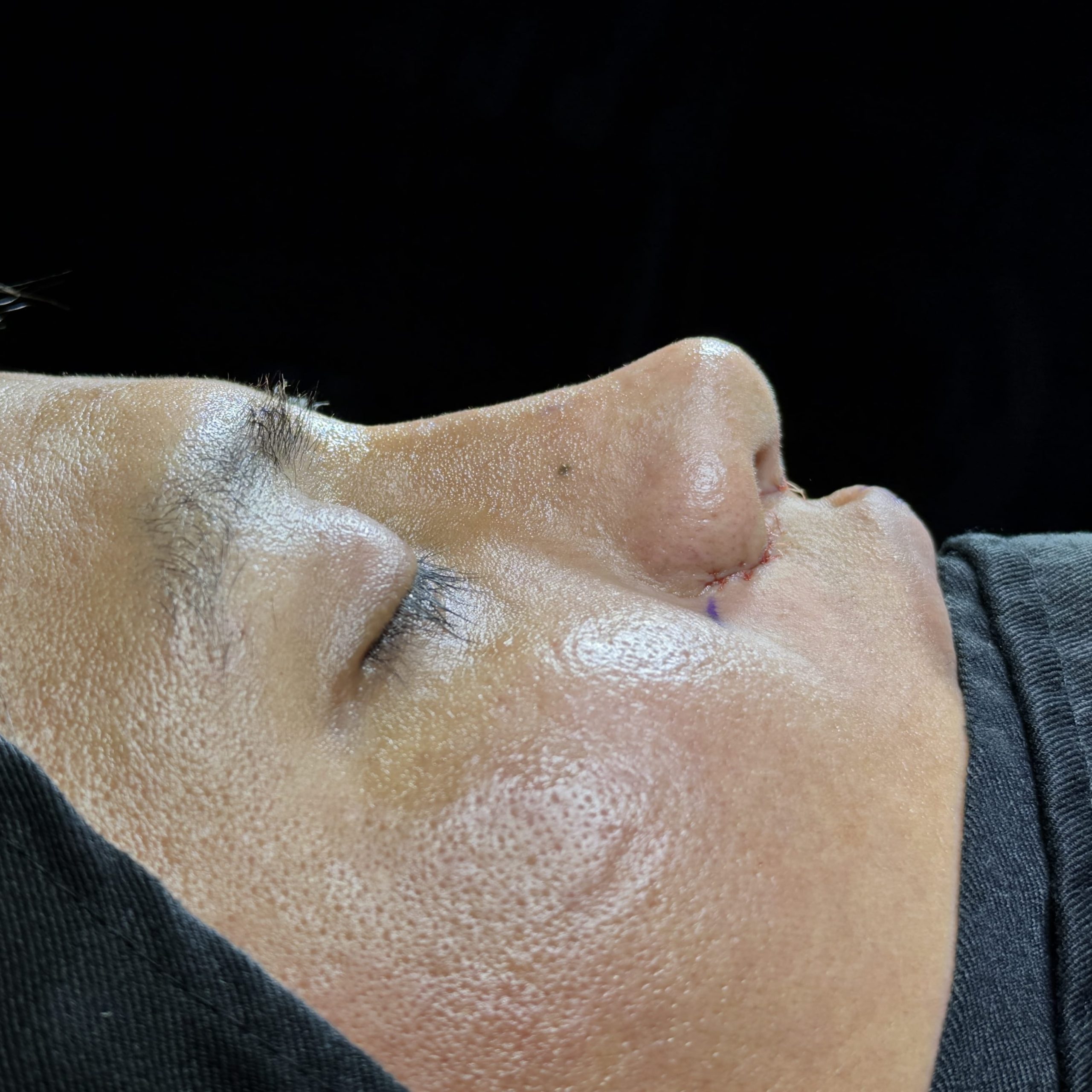 Casos de Rinoplastia